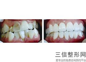 盐城牙齿矫正哪家医院好，盐城儿童牙齿矫正医院排名