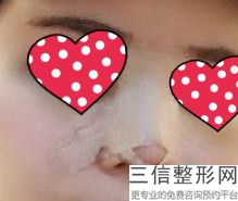 盐城做自体软骨隆鼻价格多少钱啊，软骨隆鼻大概多少钱