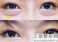 眼球突出可以割双眼皮吗图片，眼球突出可以割双眼皮吗