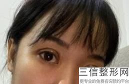 眼窝填充西安哪家医院好点，眼窝填充西安哪家医院好一点