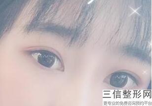 叶桐江医生做双眼皮怎么样了，西安叶桐江双眼皮