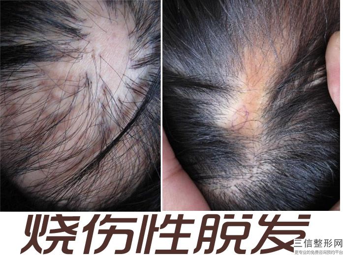 一毛囊植发需要多少钱，植发多钱一个毛囊