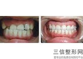 咿呀口腔种牙价格，咿呀牙科武汉