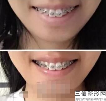 义获嘉全瓷牙价格,义获嘉铸瓷牙套多少钱一颗