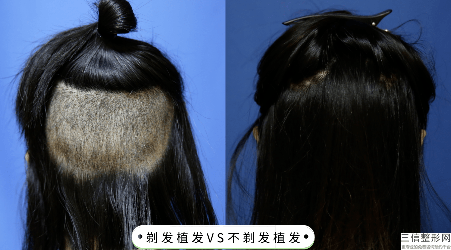 义乌植发哪家医院良好，义乌植发机构排名