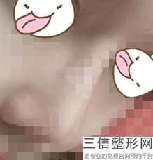 艺星玻尿酸多少钱,玻尿酸隆鼻成都价格
