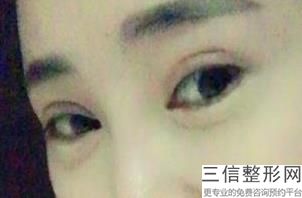 艺星修复双眼皮怎么样，高士乾双眼皮修复案例
