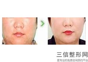 音波提拉与热玛吉的区别是什么，音波拉皮和热玛吉的区别