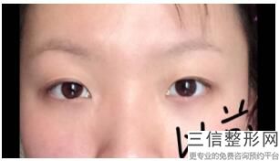 冬天适合做双眼皮手术吗(新冬天做双眼皮行吗)