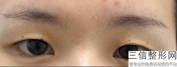 动双眼皮手术(新双眼皮手术前有哪些注意事项)