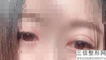 多大可以做双眼皮(新双眼皮吊顶尺寸是多少)