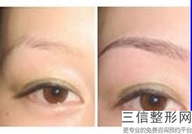 多大年龄可以双眼皮(新给17岁做埋线双眼皮医生有责任吗)
