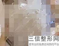 多少钱硅胶隆胸取出(新隆胸的方法有什么)