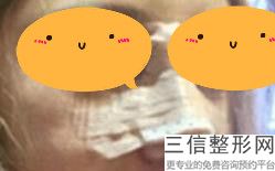 多少钱隆鼻硅胶(新鼻子手术大概多少钱)
