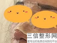 多少钱隆鼻手术(新垫个鼻子要多少钱)