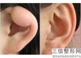 多少钱能做耳软骨隆鼻(新隆鼻手术价格)