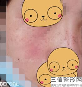 额颞部皮肤除皱术(新美白去皱面膜自制方法)
