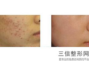 恩施美年华皮秒祛斑(新做了皮秒祛斑后能用兰蔻系列的护肤品吗)