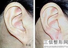 耳后筋膜隆鼻会吸收吗(新塌鼻子做隆鼻选择什么材料好)