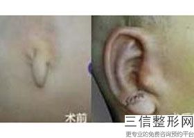 耳肋骨隆鼻可以长久吗(新肋骨隆鼻术适合什么人)