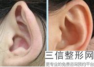 耳软骨垫隆鼻(新耳软骨隆鼻尖需要注意什么 汪垟)