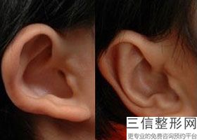 耳软骨复合隆鼻图片(新为何要用耳软骨隆鼻尖)