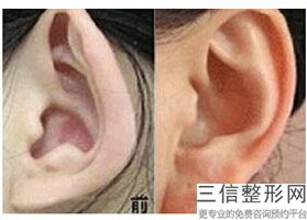 耳软骨和肋骨隆鼻有什么区别(新隆鼻中采用的自体软骨是什么)