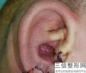 耳软骨加假体隆鼻(新假体隆鼻加耳软骨垫鼻尖的价格)