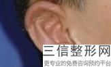 耳软骨假体隆鼻疼吗(新隆鼻大概花多少钱)