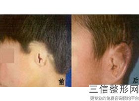 耳软骨隆鼻h(新隆鼻选硅胶or耳软骨看完别再说分不清啦)