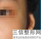 耳软骨隆鼻半年鼻尖发红(新自体软骨隆鼻疼吗)