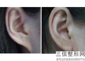 耳软骨隆鼻半年了鼻尖还是硬硬的(新做完膨体耳软骨鼻综合一个月了)
