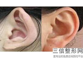 耳软骨隆鼻被撞了一下有事吗(新肋骨隆鼻术适合什么人)