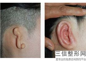 耳软骨隆鼻鼻尖发红(新现役军人家属医疗待遇较新政策2022)