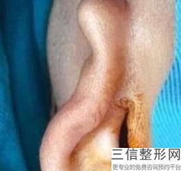 耳软骨隆鼻鼻尖红(新刘彦军自体软骨隆鼻要注意什么可以吗)