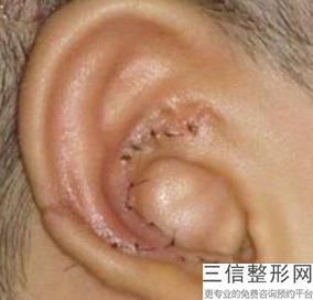 耳软骨隆鼻鼻尖下旋(新军人父母体检有何政策)