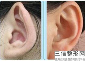 耳软骨隆鼻鼻尖硬(新软骨组织隆鼻可以到什么地方做期待答案)