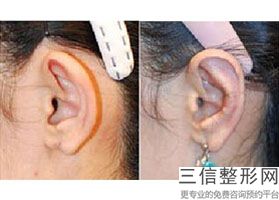 耳软骨隆鼻鼻头大怎么办(新鼻中隔软骨隆鼻尖在北京哪里好)