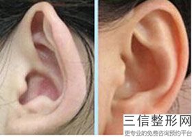 耳软骨隆鼻鼻头多久会被吸收(新鼻综合要休息多久)