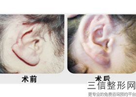 耳软骨隆鼻鼻头太尖怎么办(新鼻中隔软骨隆鼻尖在北京哪里好)