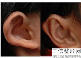 耳软骨隆鼻鼻头越来越大(新全肋软骨隆鼻和半肋软骨隆鼻区别在哪)