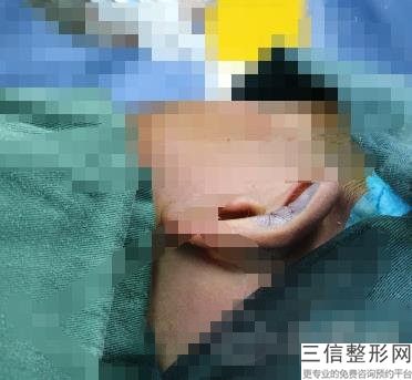 耳软骨隆鼻鼻子不(新耳软骨垫鼻尖好不好)