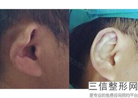 耳软骨隆鼻创伤大吗？(新一起来了解各种隆鼻方式优缺点)