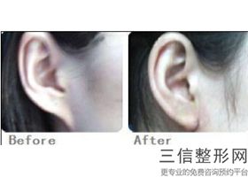 耳软骨隆鼻的报价(新自体肋软骨隆鼻多少钱)