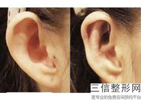 耳软骨隆鼻的价位(新为何要用耳软骨隆鼻尖)