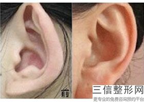 耳软骨隆鼻的手术价格(新鼻子垫软骨得多少钱)