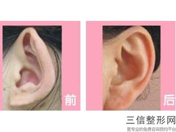 耳软骨隆鼻的优势(新耳软骨硅胶隆鼻怎么样)