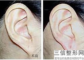耳软骨隆鼻垫鼻尖(新耳软骨垫鼻尖会感染吗)
