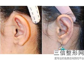 耳软骨隆鼻雕刻图片(新耳软骨隆鼻效果是长久的吗)