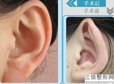 耳软骨隆鼻多久不痛(新假体+耳软骨隆鼻.术后第八天鼻子没变化)